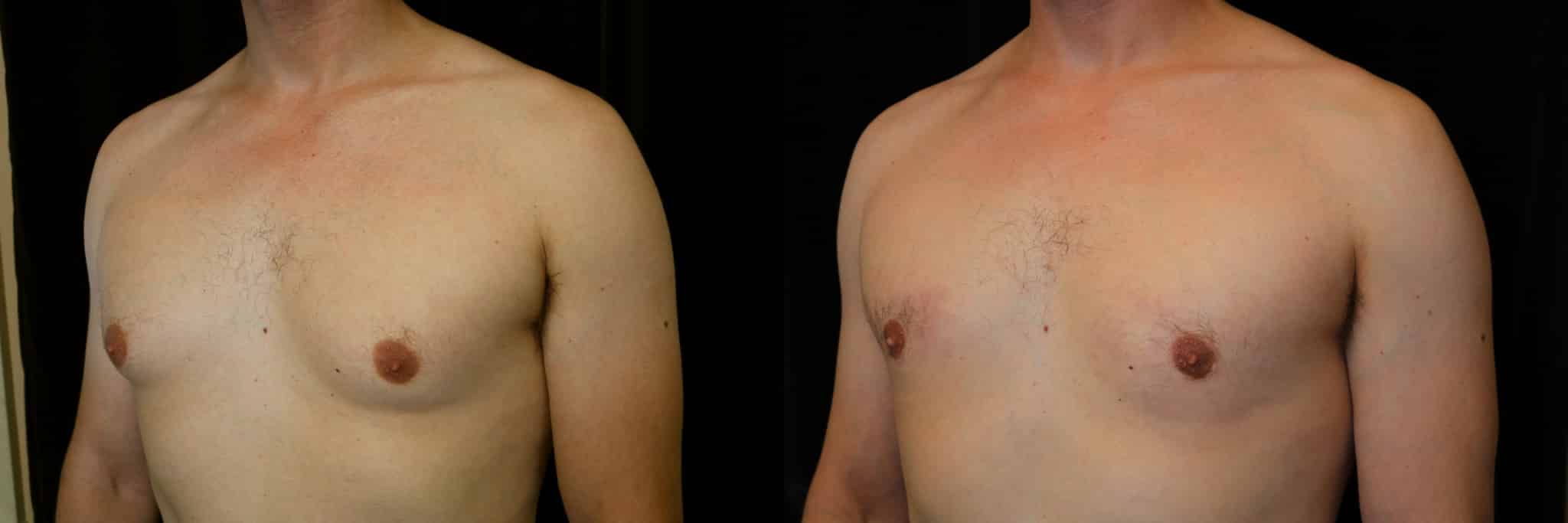 Gynecomastia Patient 11 Before & After Details