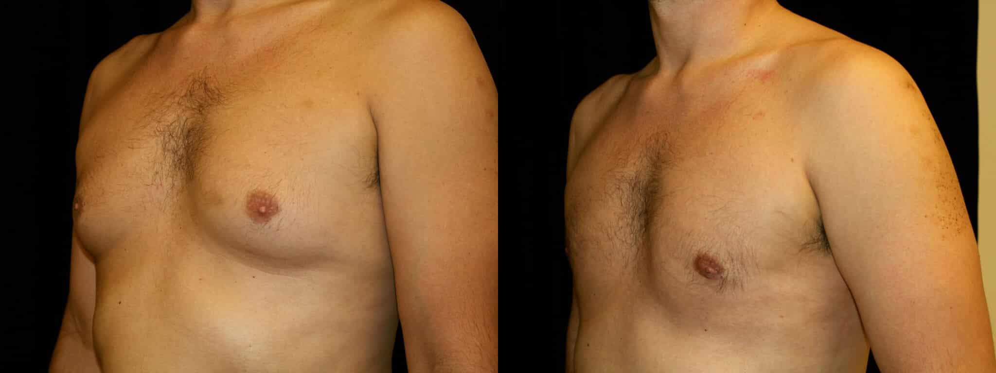 Gynecomastia Patient 21 Before & After Details