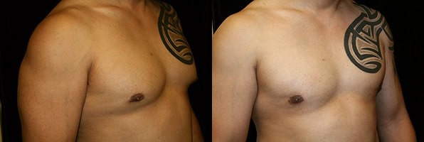 Gynecomastia Patient 2 Before & After Details