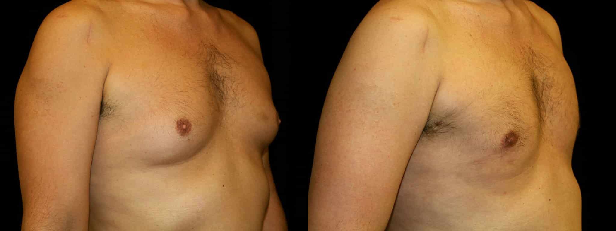 Gynecomastia Patient 21 Before & After Details