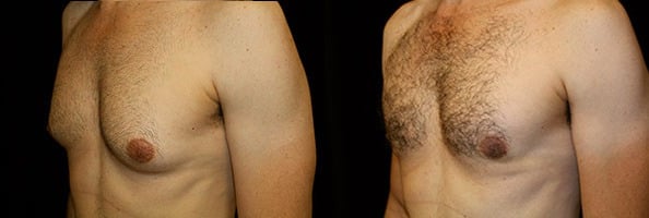 Gynecomastia Patient 18 Before & After Details