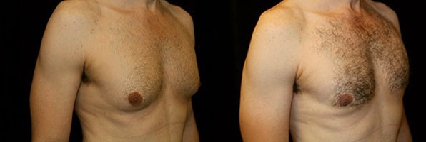 Gynecomastia Patient 18 Before & After Details