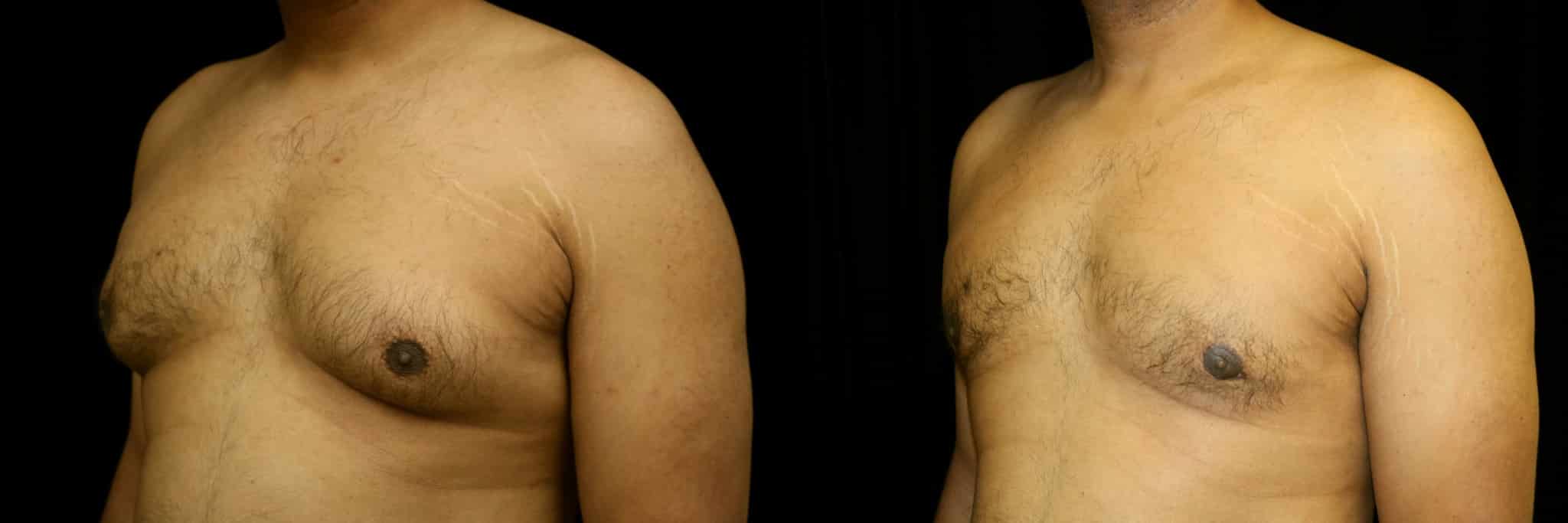 Gynecomastia Patient 10 Before & After Details