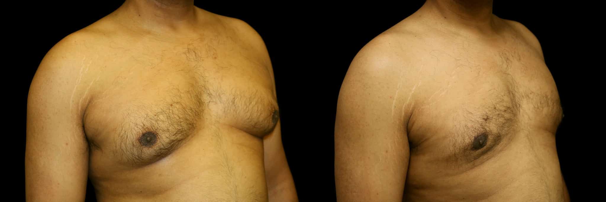 Gynecomastia Patient 10 Before & After Details