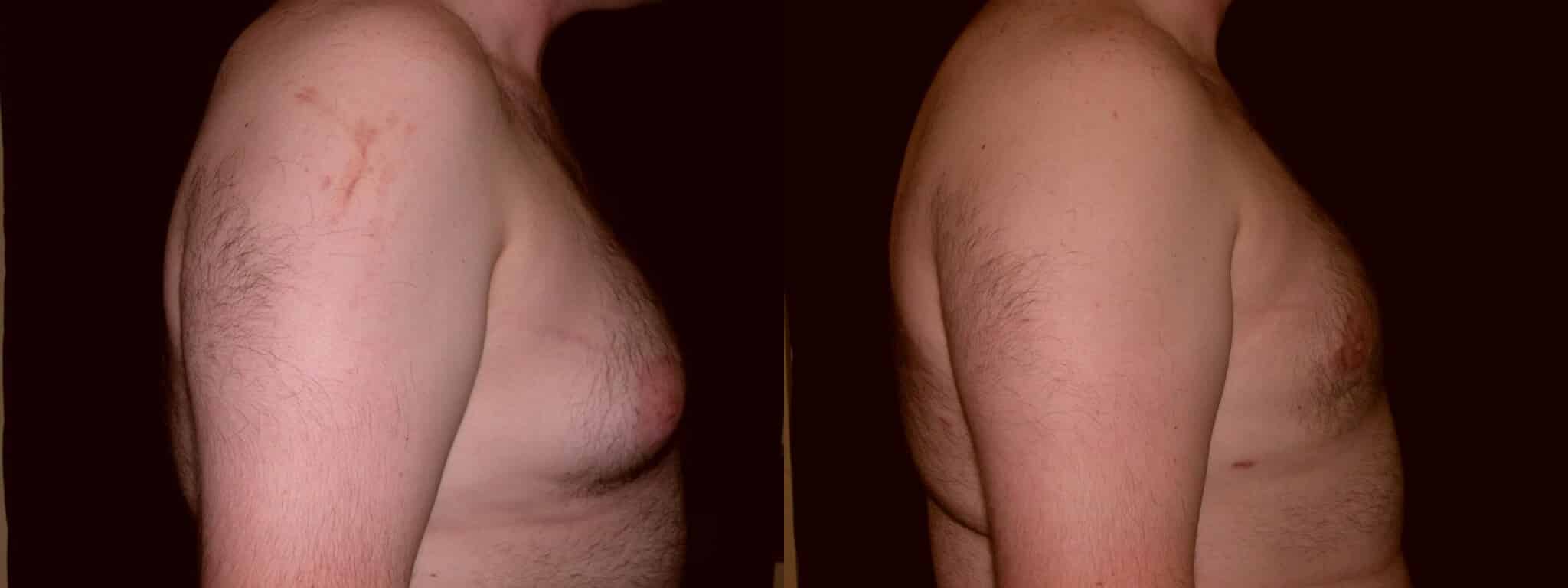 Gynecomastia Patient 11 Before & After Details