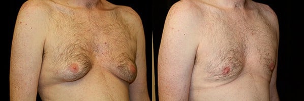 Gynecomastia Patient 20 Before & After Details