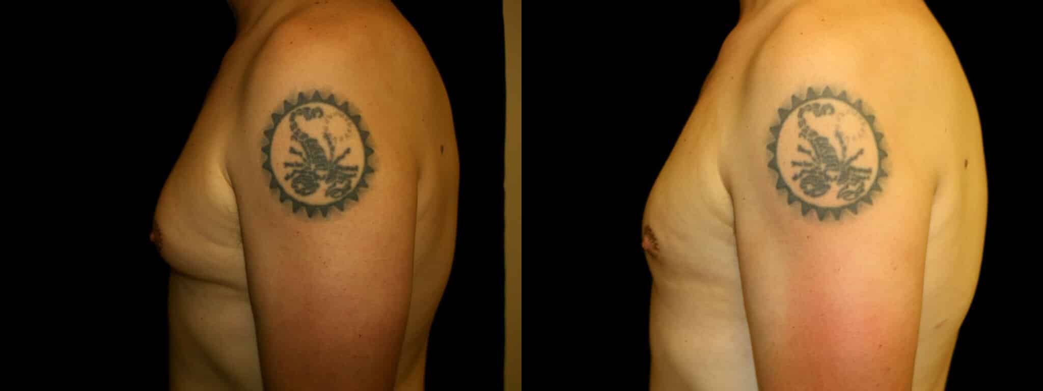 Gynecomastia Patient 11 Before & After Details