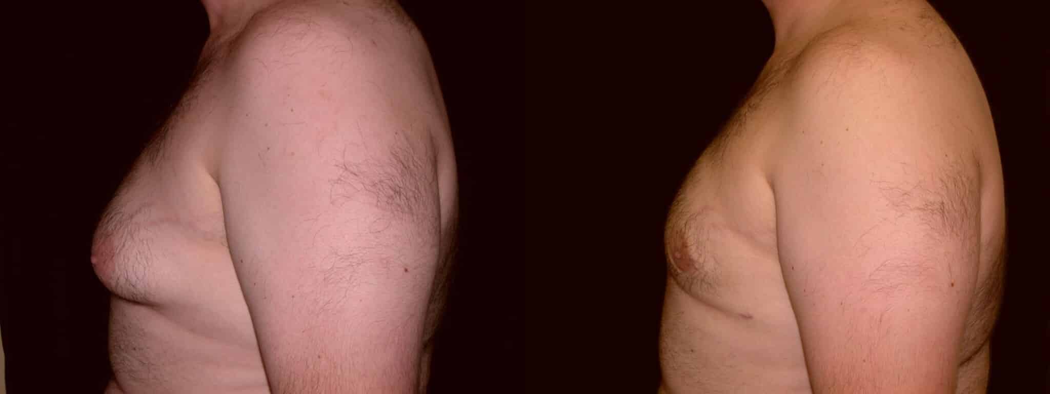 Gynecomastia Patient 11 Before & After Details