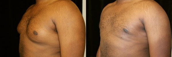 Gynecomastia Patient 19 Before & After Details