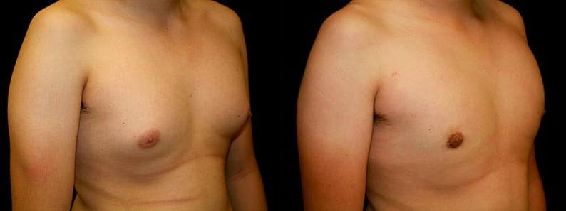 Gynecomastia Patient 4 Before & After Details