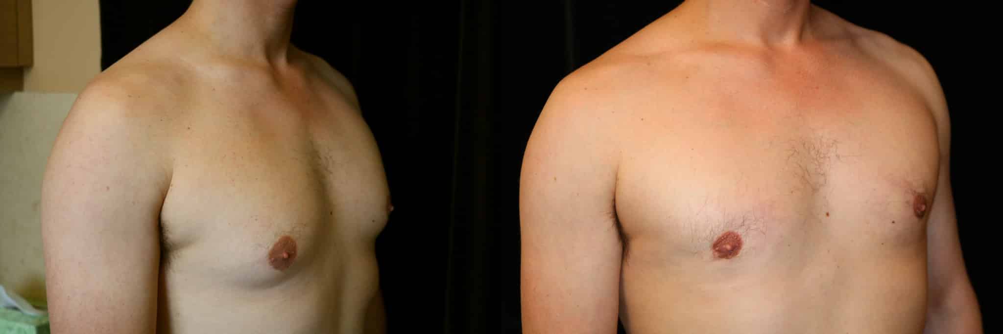 Gynecomastia Patient 11 Before & After Details