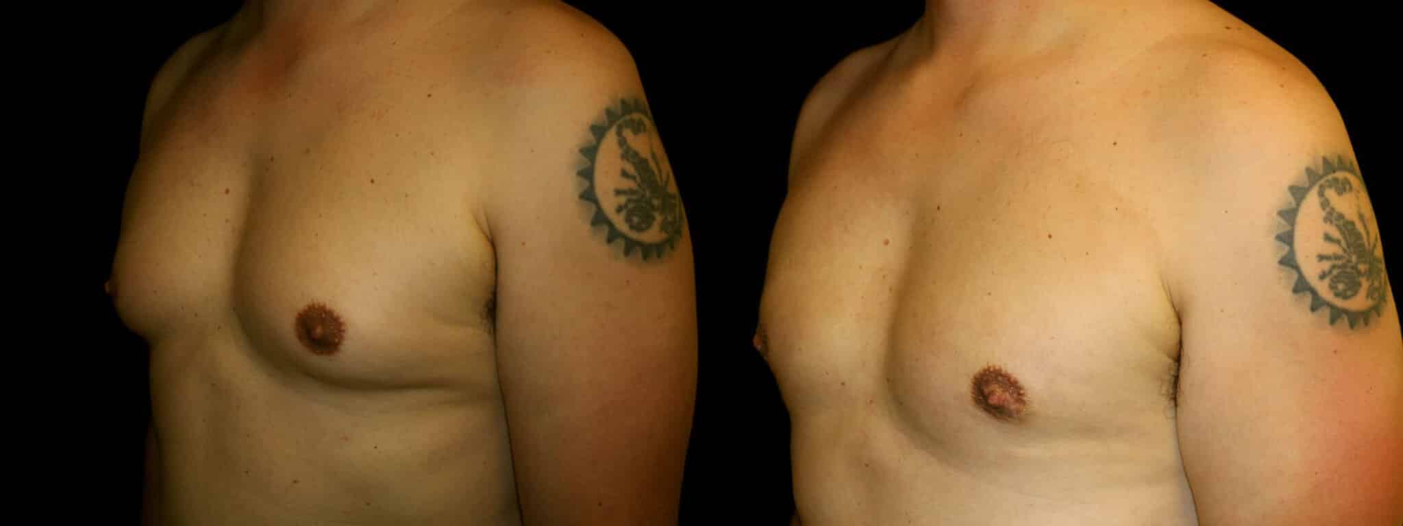 Gynecomastia Patient 11 Before & After Details