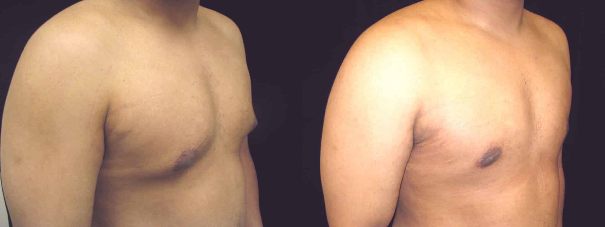 Gynecomastia Patient 20 Before & After Details