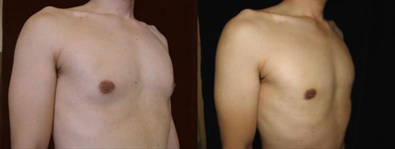 Gynecomastia Patient 5 Before & After Details