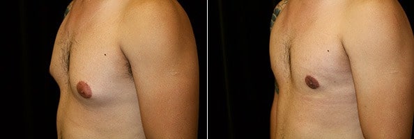 Gynecomastia Patient 6 Before & After Details