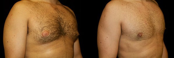 Gynecomastia Patient 19 Before & After Details