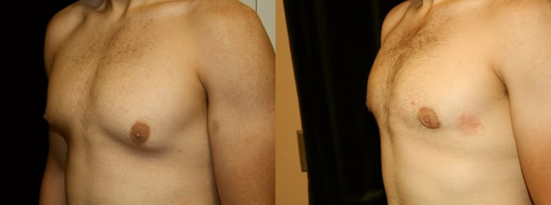 Gynecomastia Patient 1 Before & After Details