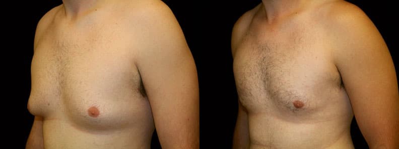 Gynecomastia Patient 11 Before & After Details