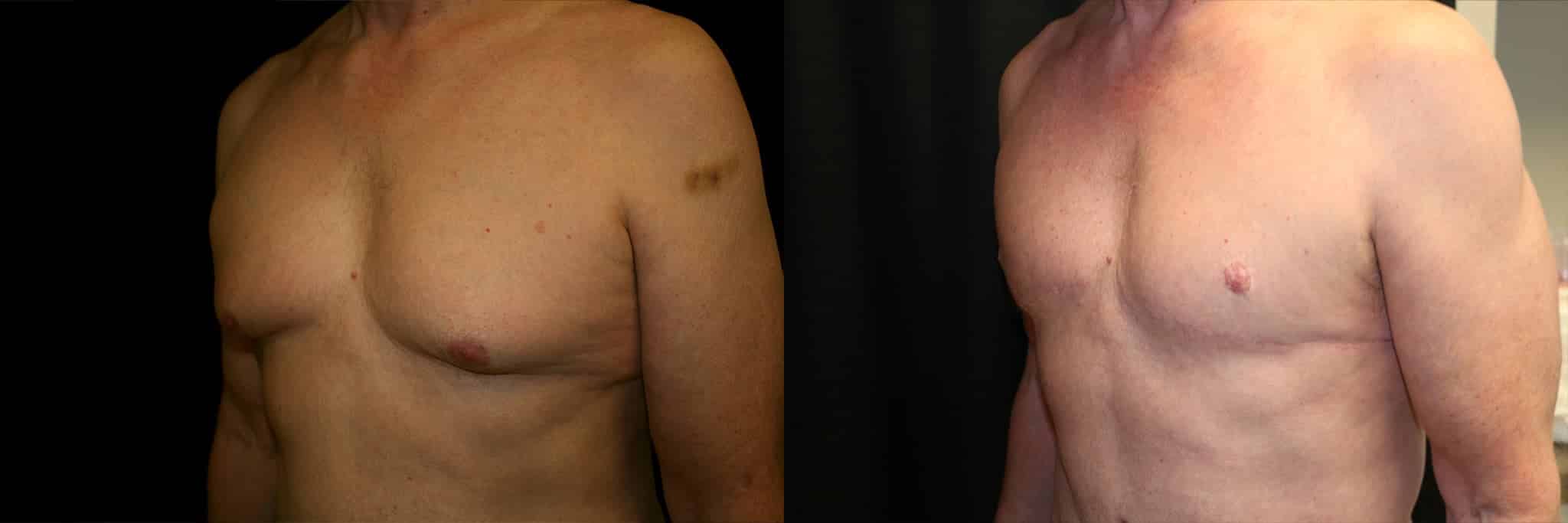 Gynecomastia Patient 18 Before & After Details