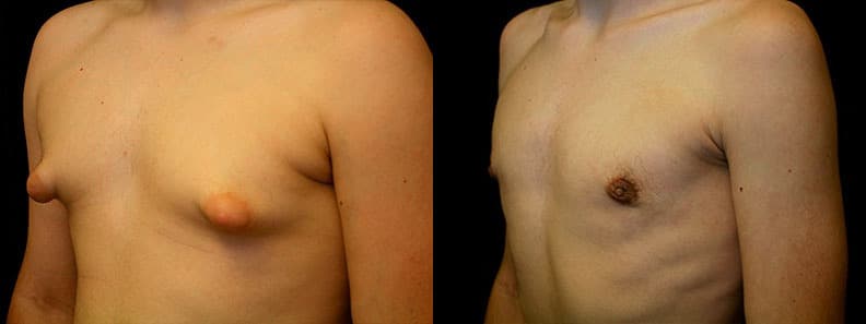 Gynecomastia Patient 7 Before & After Details