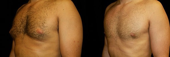 Gynecomastia Patient 19 Before & After Details