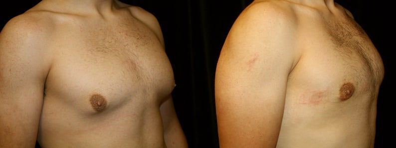 Gynecomastia Patient 1 Before & After Details