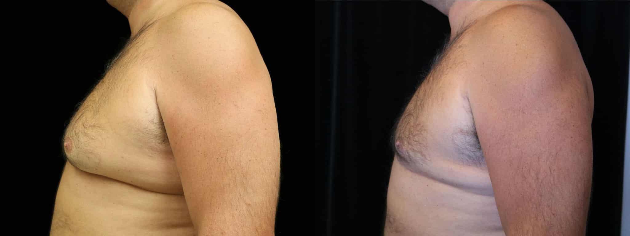 Gynecomastia Patient 19 Before & After Details