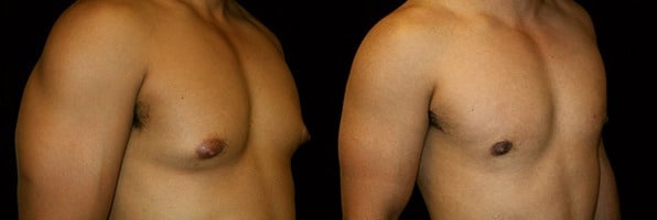 Gynecomastia Patient 1 Before & After Details