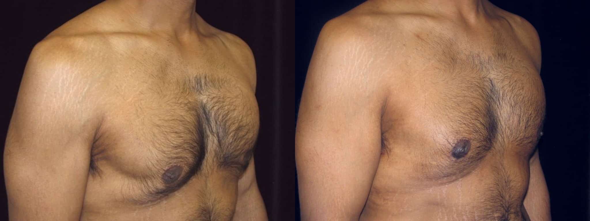 Gynecomastia Patient 5 Before & After Details