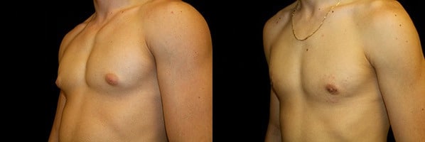 Gynecomastia Patient 14 Before & After Details