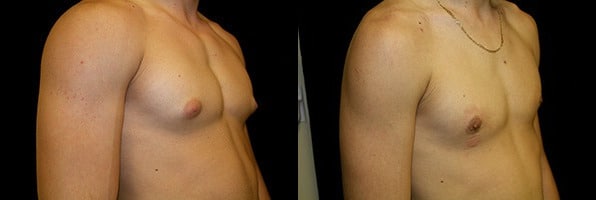 Gynecomastia Patient 14 Before & After Details