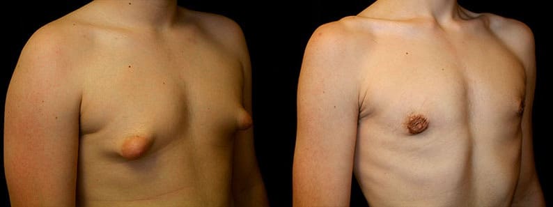 Gynecomastia Patient 7 Before & After Details