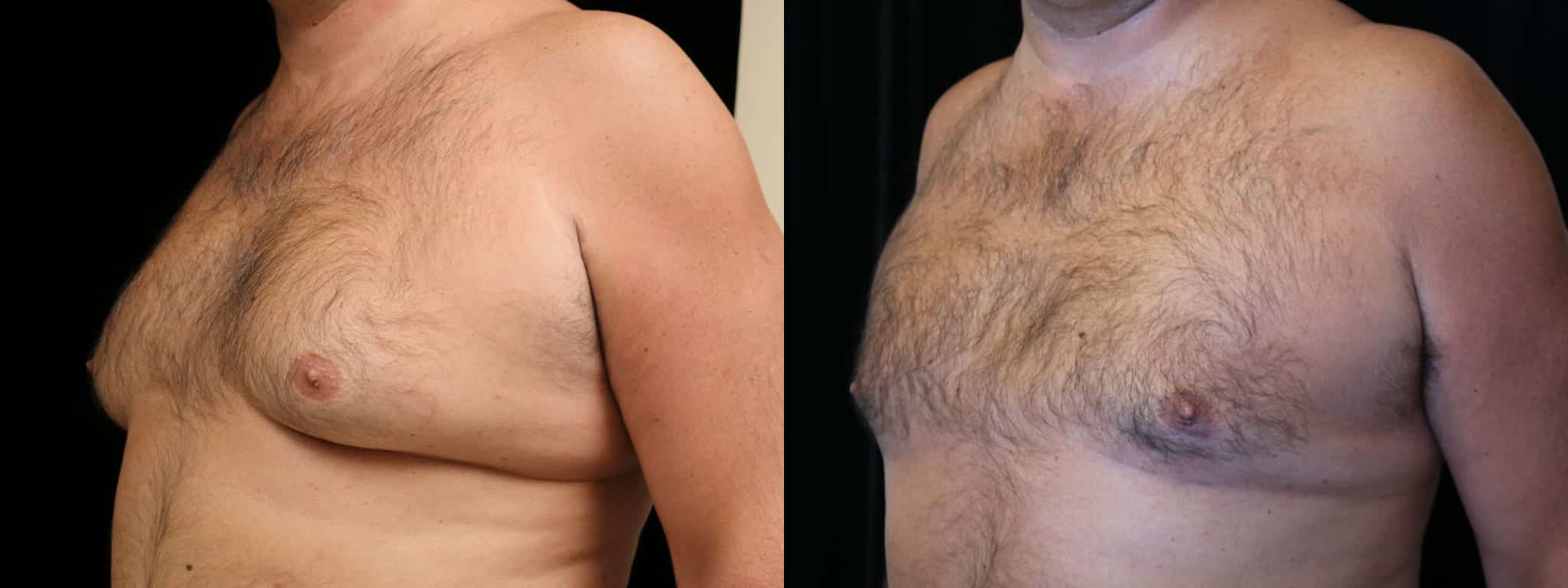 Gynecomastia Patient 19 Before & After Details