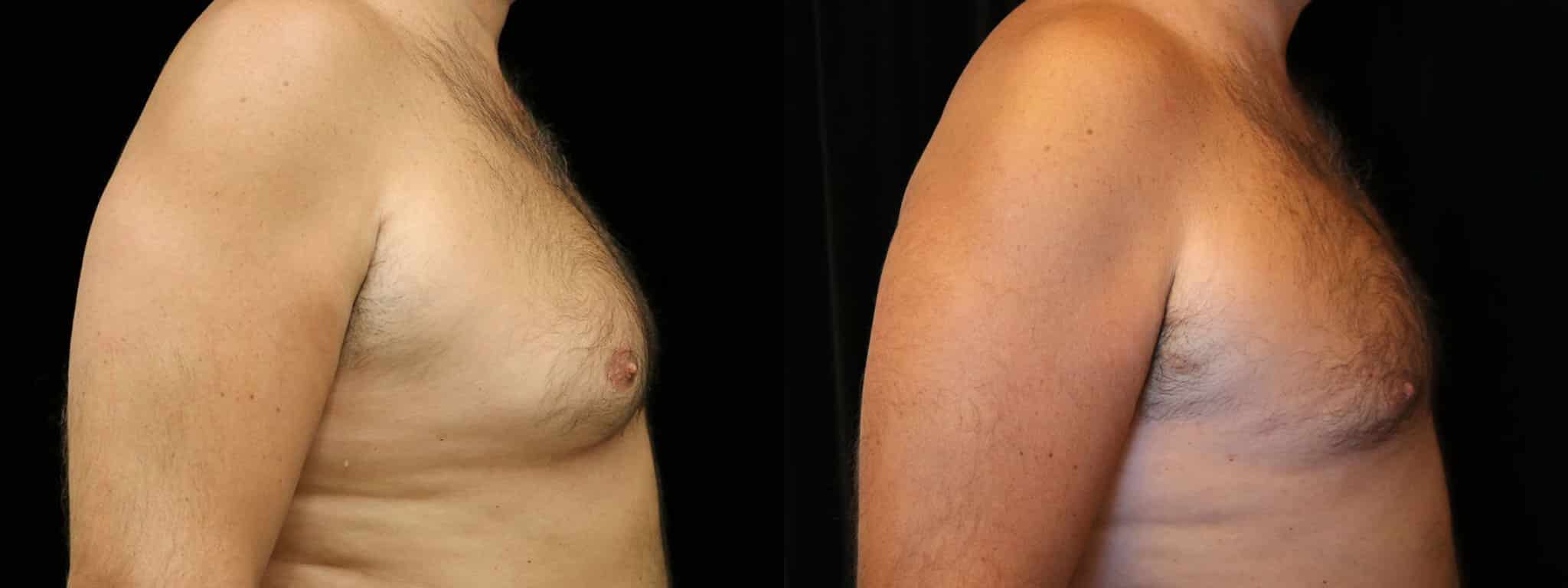 Gynecomastia Patient 19 Before & After Details