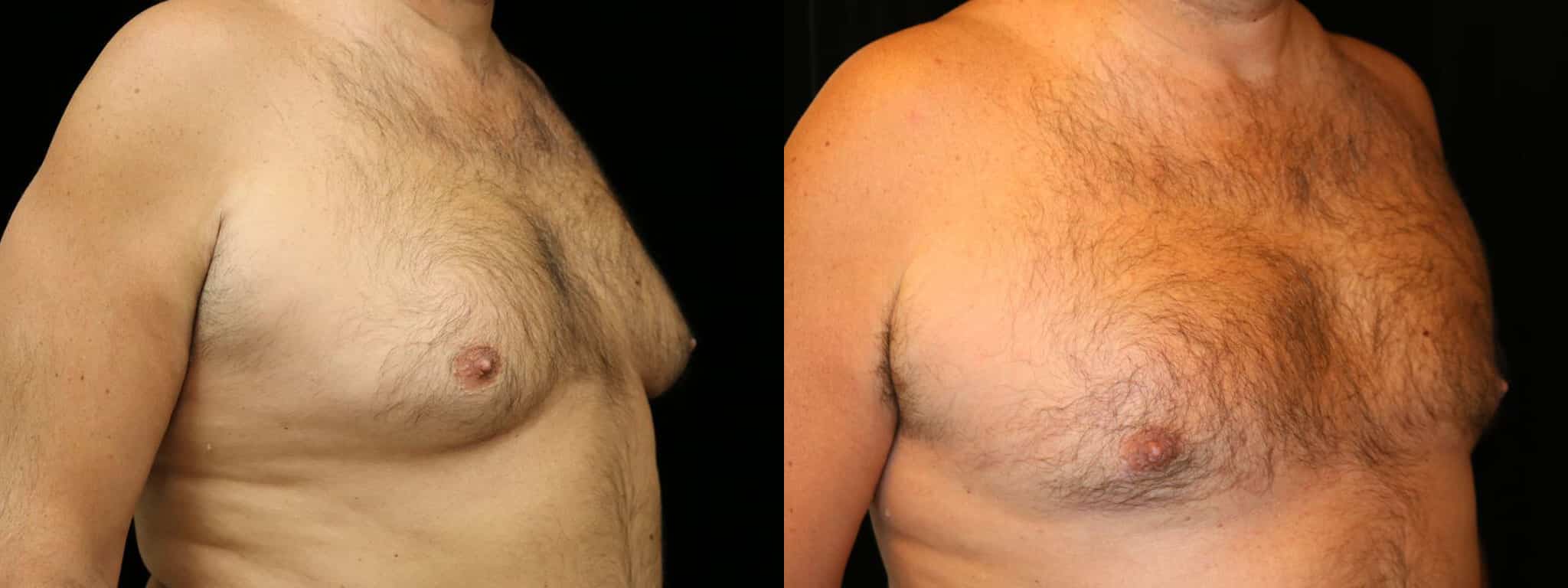 Gynecomastia Patient 19 Before & After Details