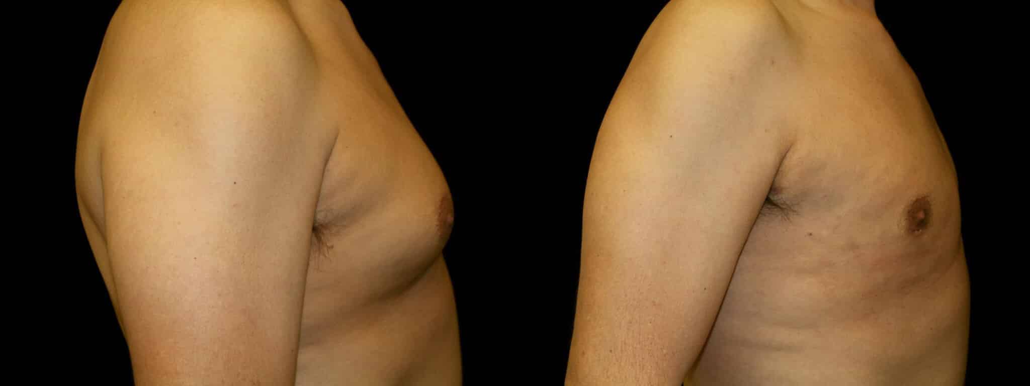 Gynecomastia Patient 6 Before & After Details