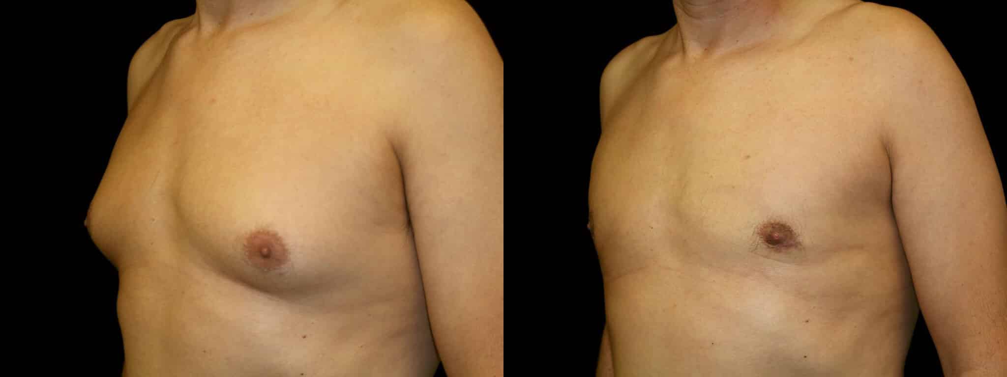 Gynecomastia Patient 6 Before & After Details