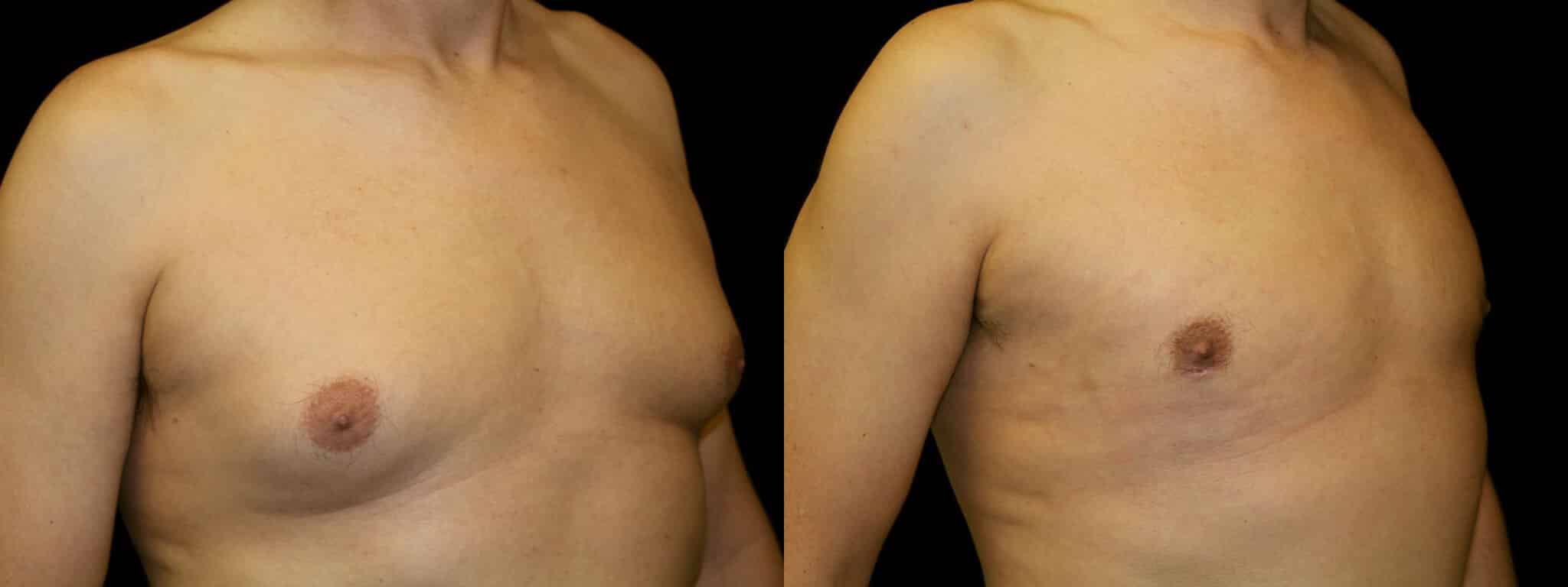 Gynecomastia Patient 6 Before & After Details