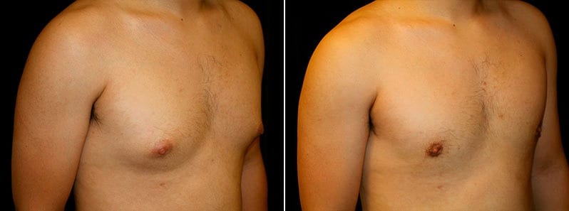 Gynecomastia Patient 5 Before & After Details