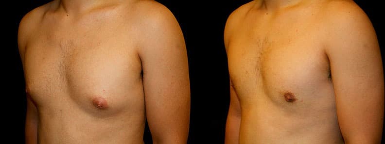 Gynecomastia Patient 5 Before & After Details