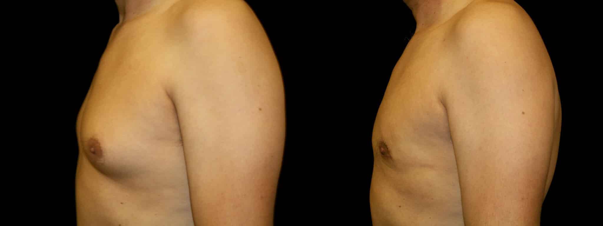 Gynecomastia Patient 6 Before & After Details