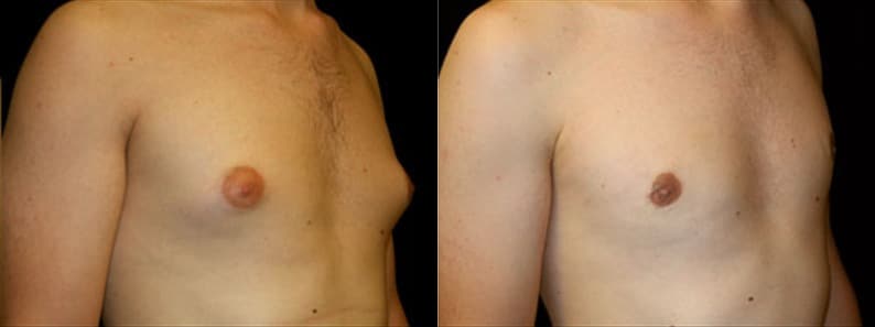 Gynecomastia Patient 6 Before & After Details