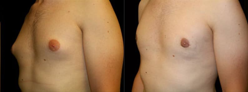 Gynecomastia Patient 6 Before & After Details