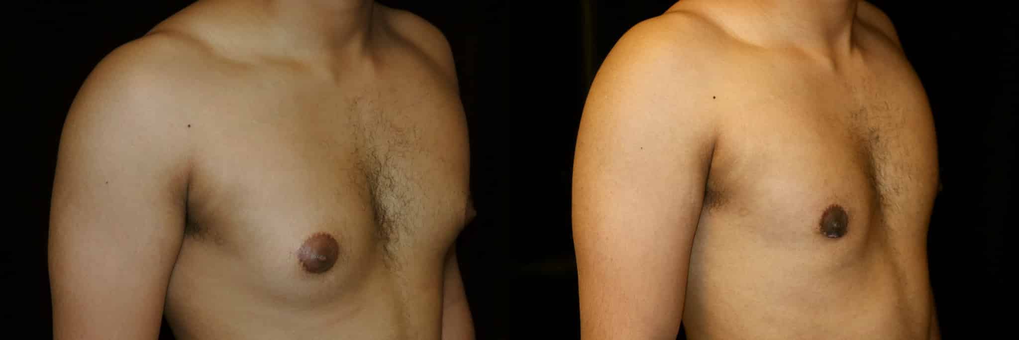 Gynecomastia Patient 16 Before & After Details