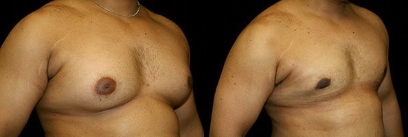 Gynecomastia Patient 9 Before & After Details