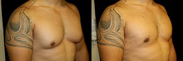 Gynecomastia Patient 12 Before & After Details