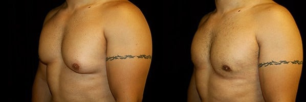 Gynecomastia Patient 12 Before & After Details