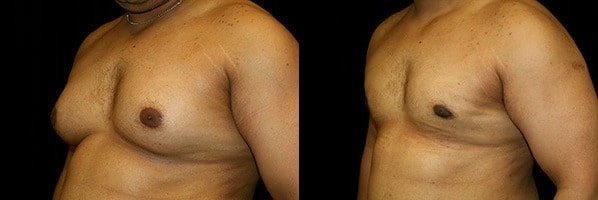 Gynecomastia Patient 9 Before & After Details