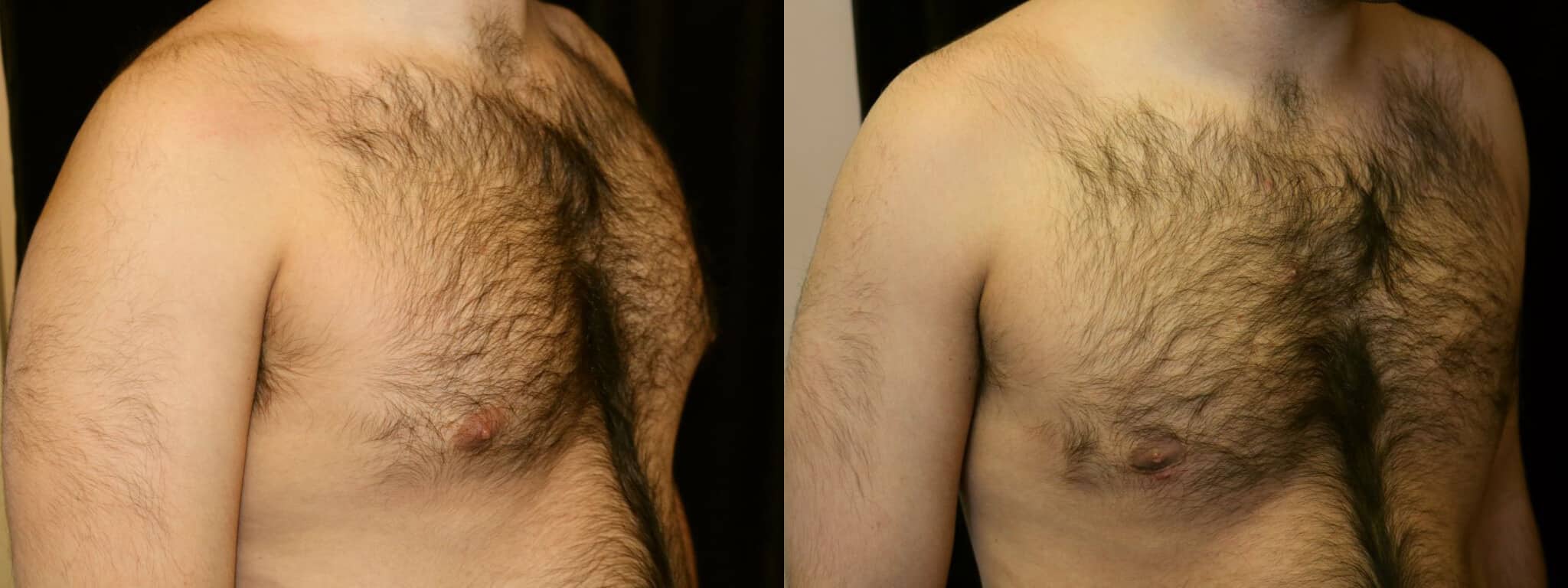 Gynecomastia Patient 14 Before & After Details