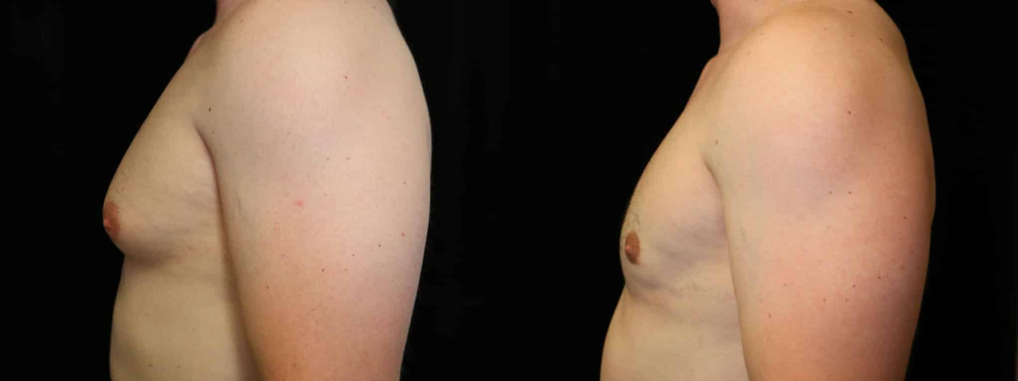 Gynecomastia Patient 5 Before & After Details